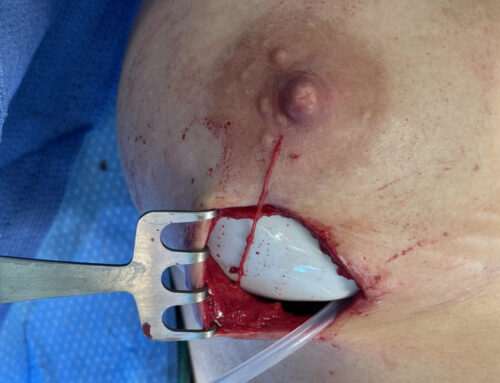 Sensation Preserving Mastectomy Surgery