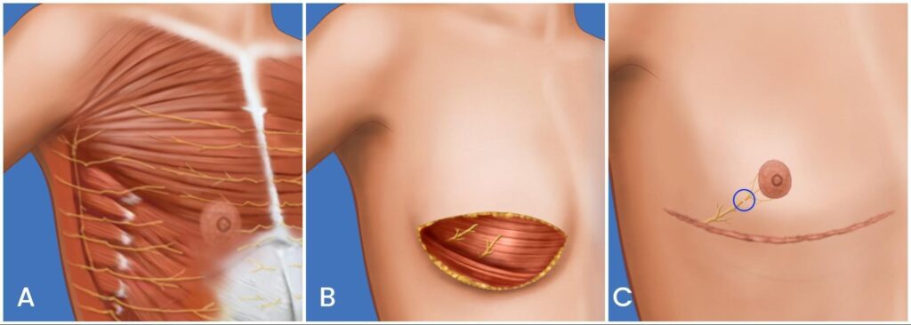 Sensation preservation technique illustration